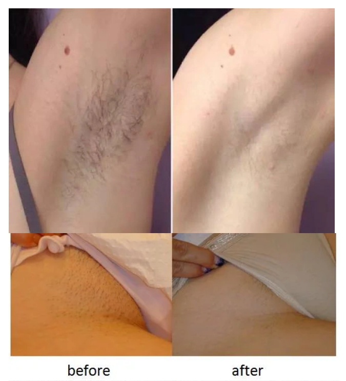 diode laser hair removal before and after