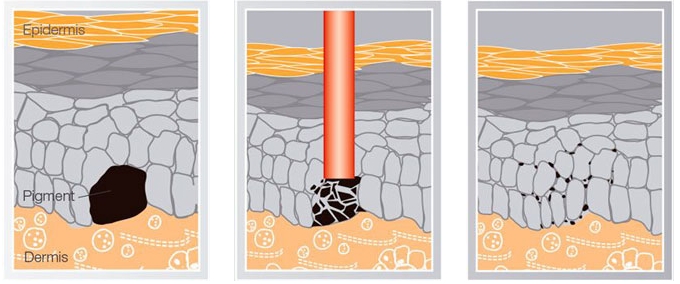 nd yag laser before and after