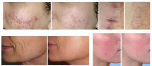 CO2 Fractional Laser Skin Resurfacing System5