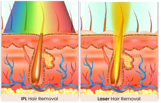 comparison between IPL and Diode laser