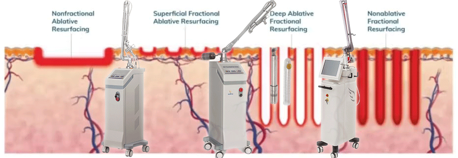 fractional co2 laser resurfacing before and after