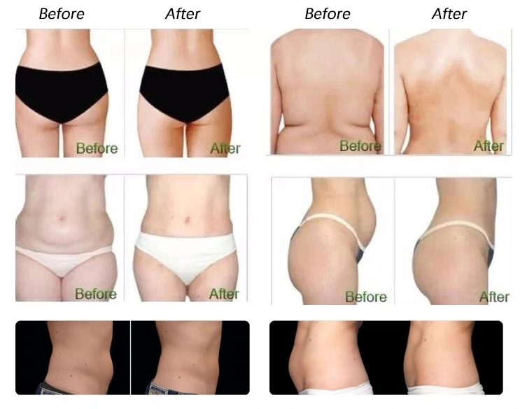 coolsculpting before and after