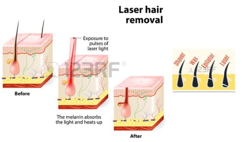 diode laser hair removal before and after