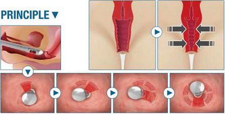 Fractional CO2 Laser Vaginal Rejuvenation principle 