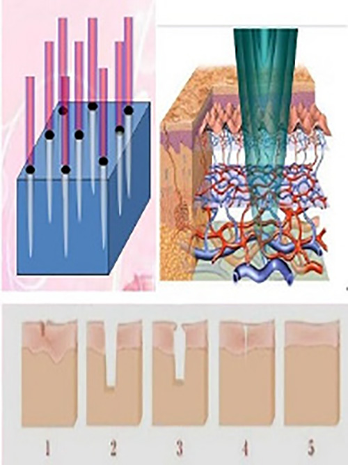 co2 laser skin resurfacing before and after