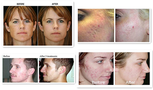 fractional co2 laser resurfacing before and after