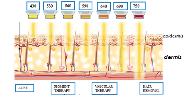 IPL-treatment-for-acne-rejuvenation-Wavelength