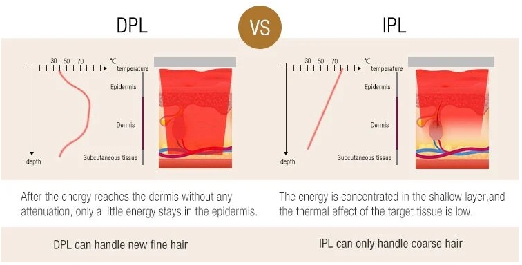 Ipl-dpl-difference