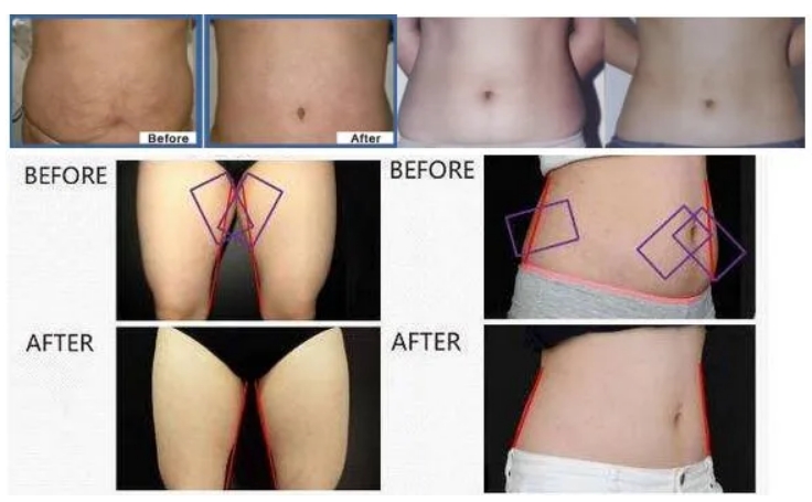  Negative-pressure-vaccum-Rf-Body-Slimming-Machine-treatment-before-and-after