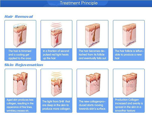 intense pulsed light therapy before and after