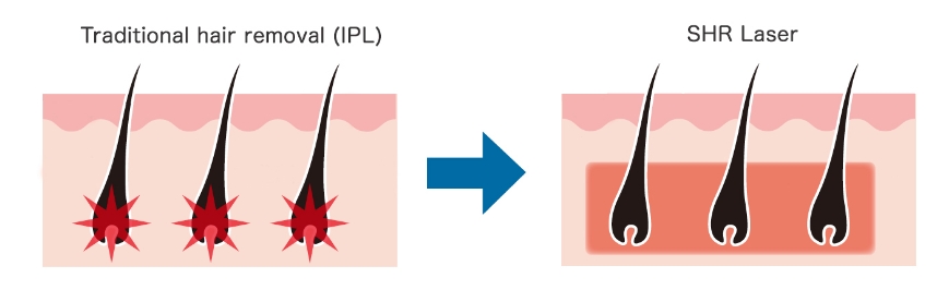 intense pulsed light vs laser hair removal