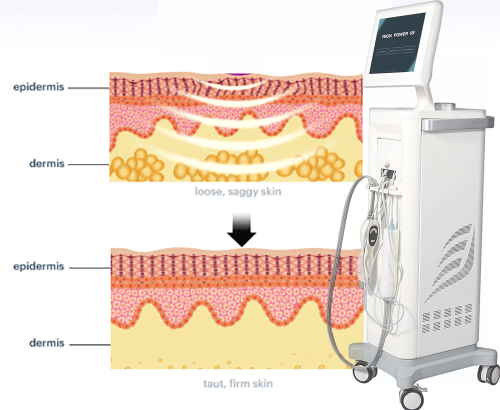 thermage before and after