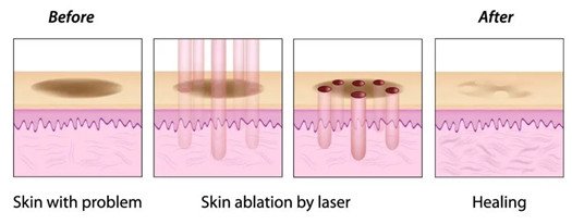 fractional co2 laser treatment