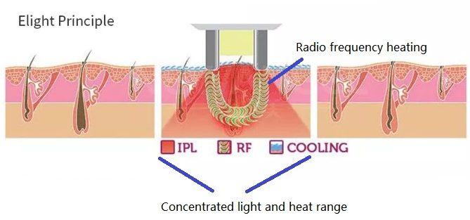 e-light-ipl-machine-work-principle