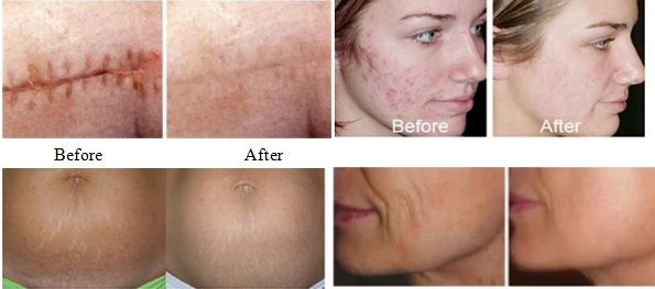 fractional co2 laser before and after