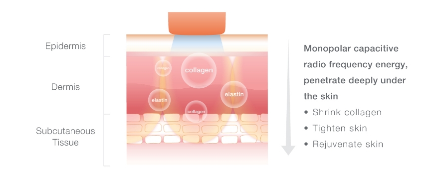 monopolar-rf-machine-treatment-principle