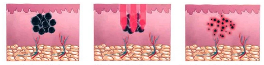 nd yag laser before and after