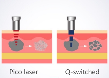 pico-laser-vs-Q-switched