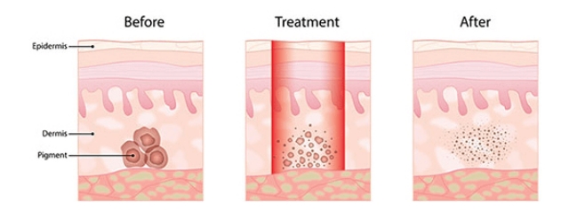 picosecond-tattoo-removal-treatment-principle