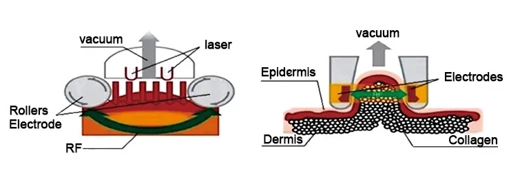 principle-of-vacuum-rf-slimming-machine