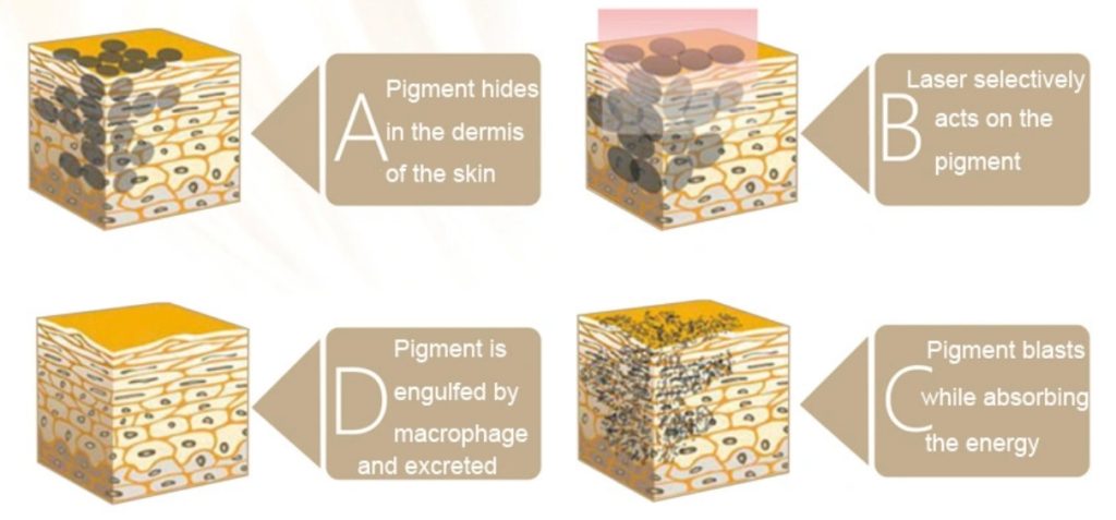 nd yag laser before and after