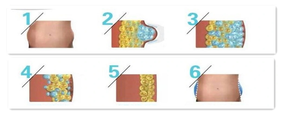 before and after cryolipolysis