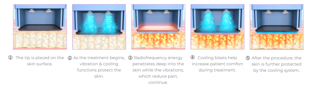 what is thermage treatment