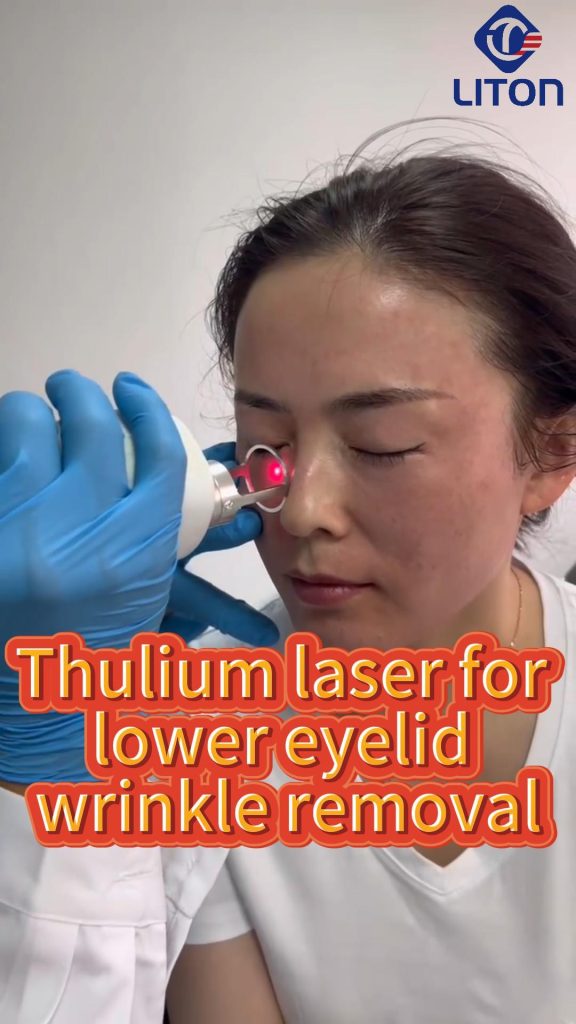 1927nm Thulium laser for wrinkle removal under the eyelid