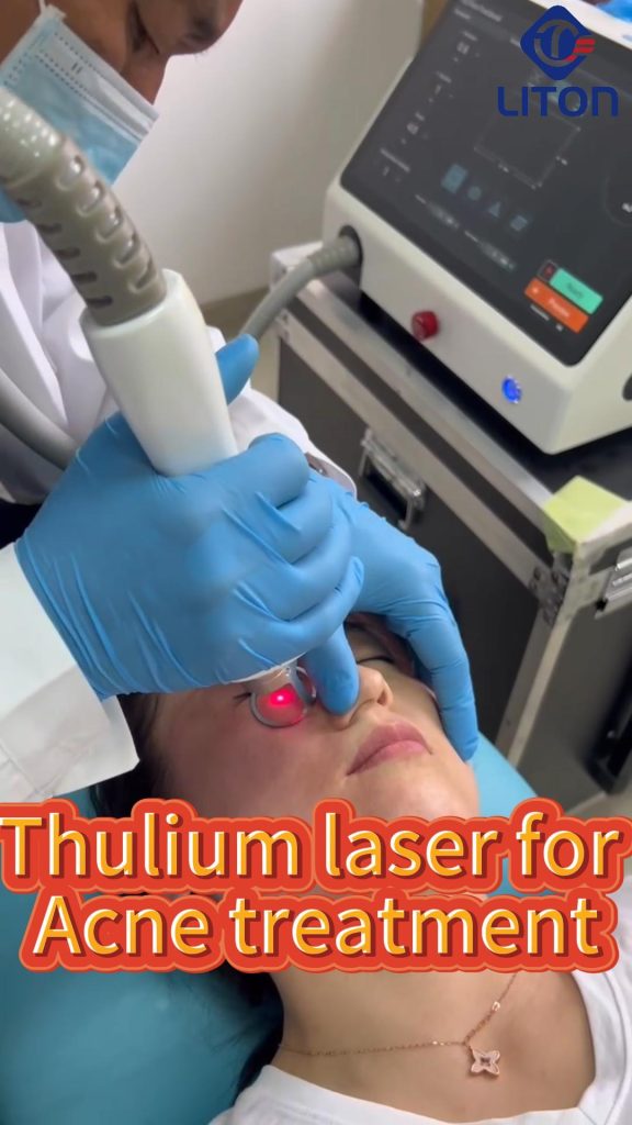 1927nm Thulium laser to remove acne