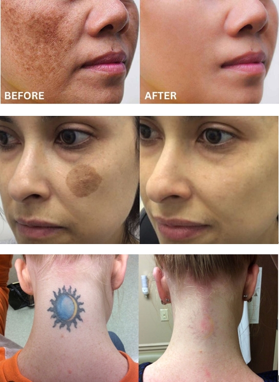 nd yag laser before and after