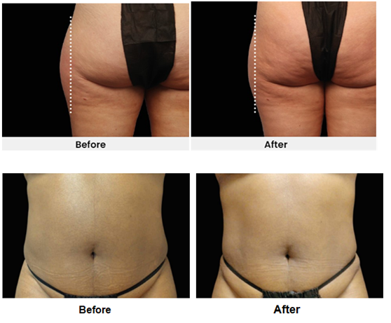 EMS sculptor body slimming device before and after