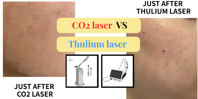 CO2 laser VS thulium laser