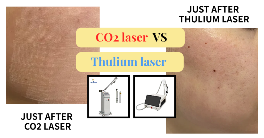 Comparison between CO2 fractional laser and 1927nm fractional thulium laser