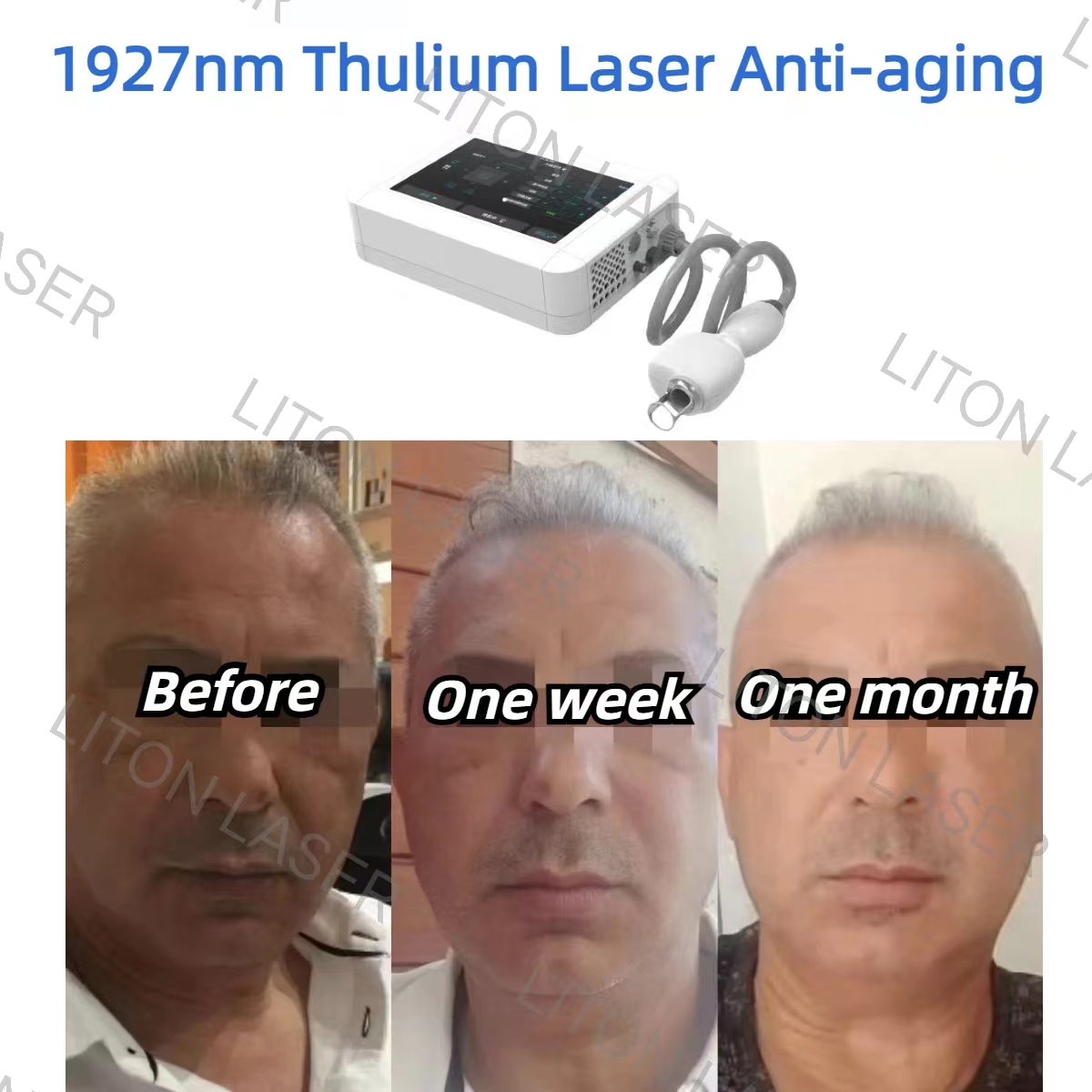 1927nm thulium laser anti-aging before and after photos