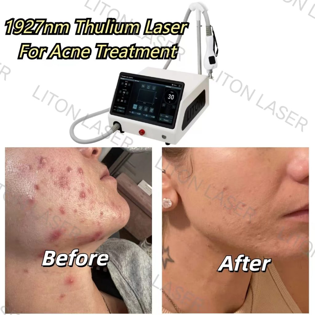 Before and after treatment of acne with 1927nm thulium laser