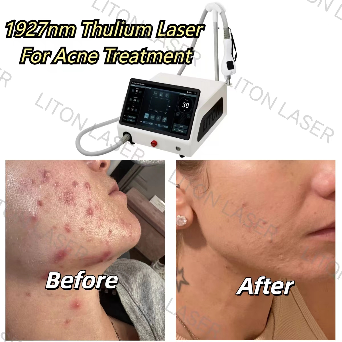 Before and after treatment of acne with 1927nm thulium laser