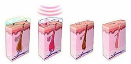 ipl hair removal device how to use