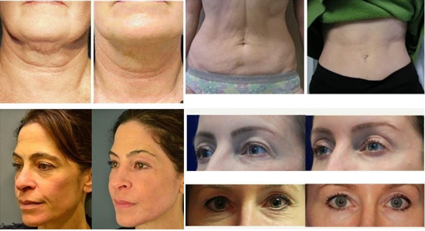 thermage-radiofrequency-monopolar-skin-lifting-treatment-before-and-after