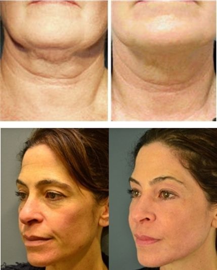 monopolar-radiofrequency-skin-tightening-before-and-after