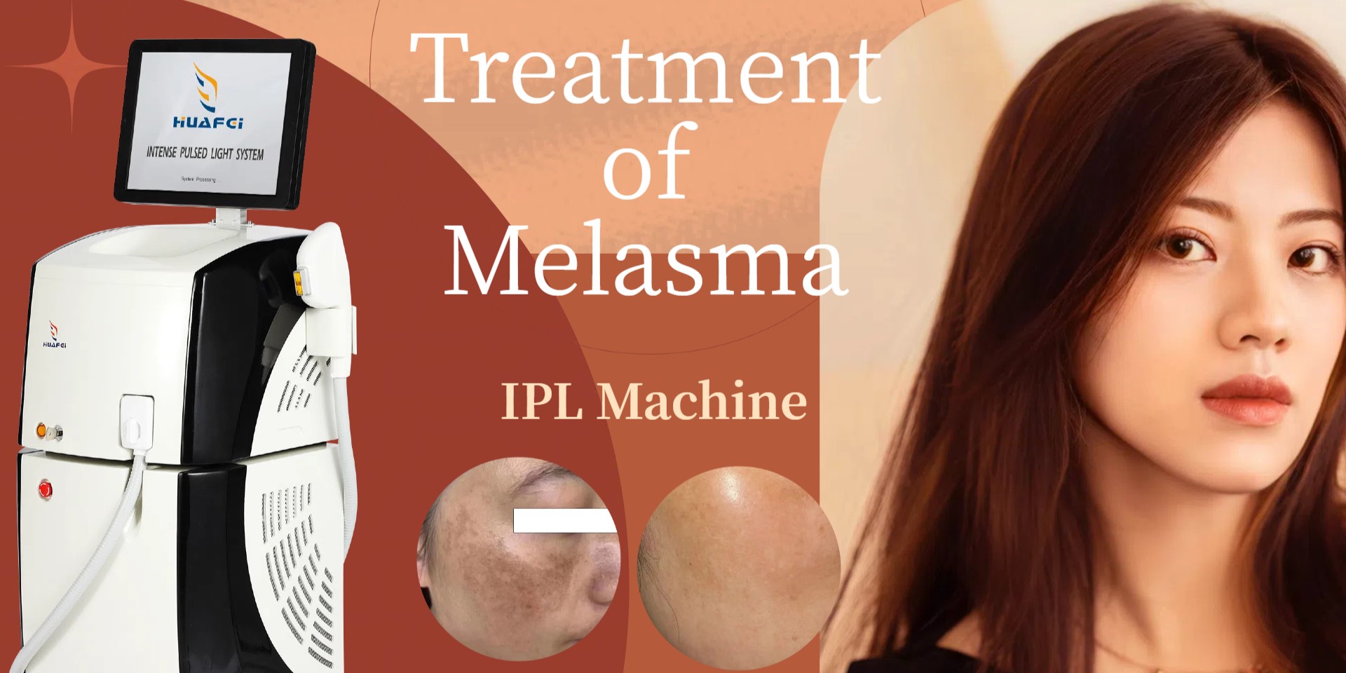 IPL Beauty Machine Intense Pulsed Light for Melasma Treatment