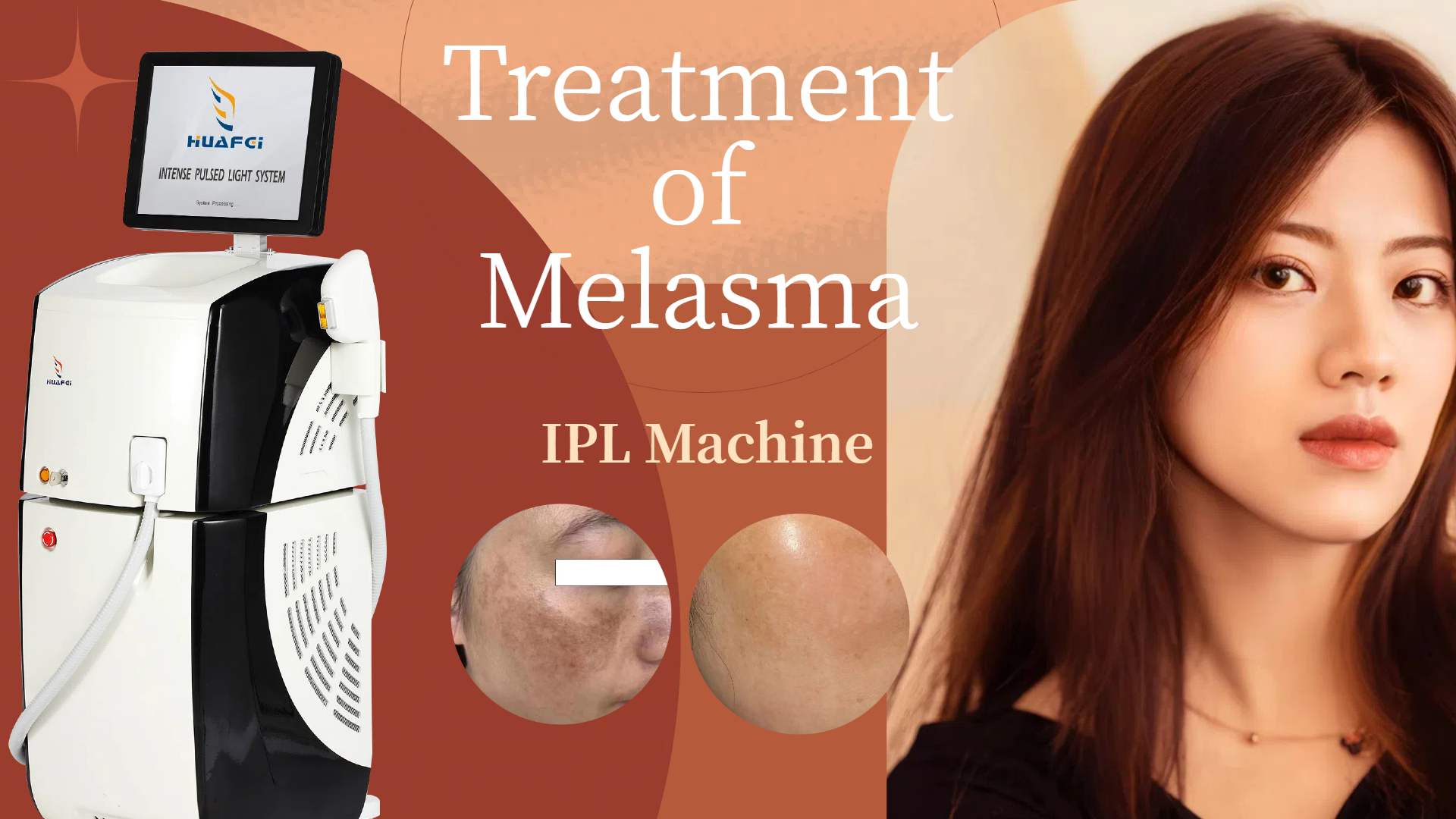 IPL Intense Pulsed Light Beauty Machine for Melasma Treatment