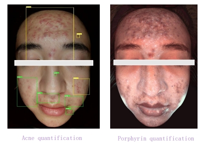 Spectrogram of skin analysis equipment - Acne Muscle