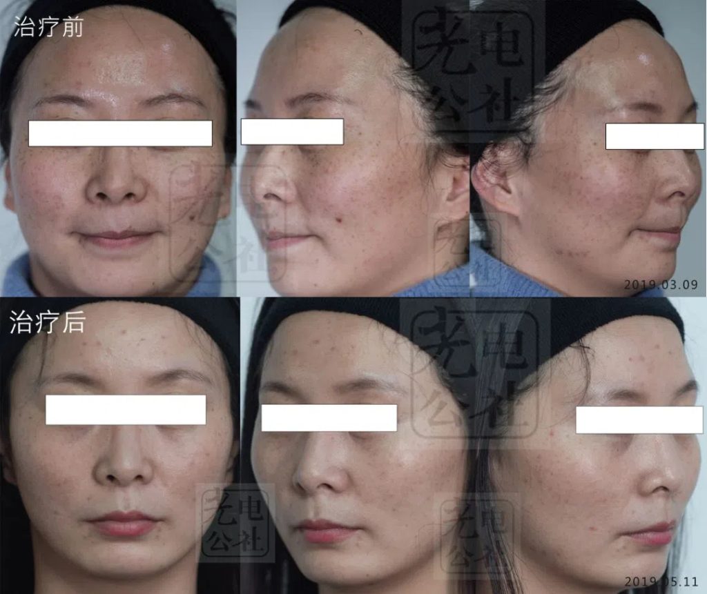 Before and after comparison of Q-switched laser removal of pigment spots