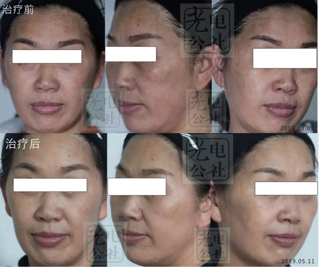 Before and after comparison of picosecond laser removal of pigment spots