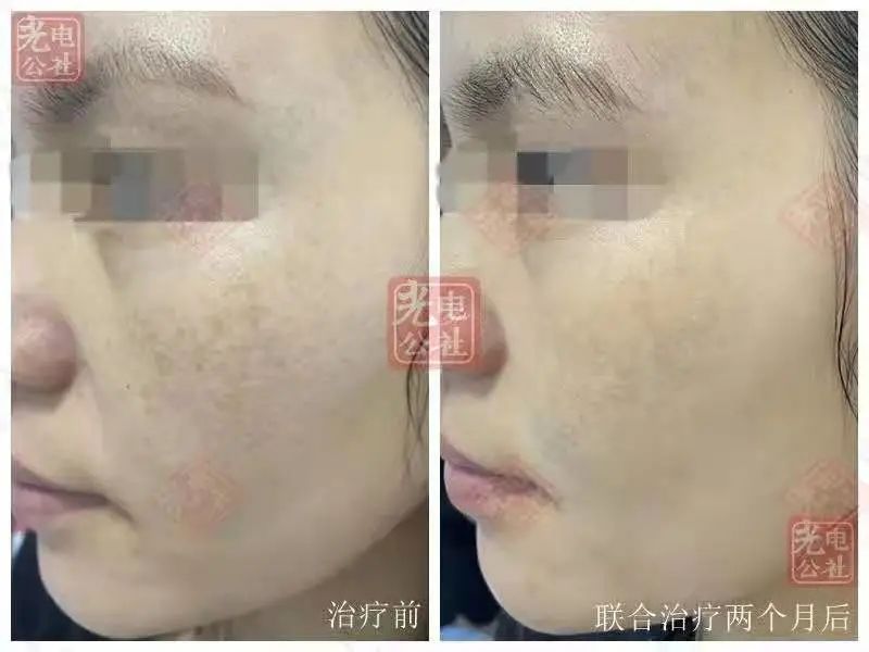 Comparison of Q-switched laser combined with salicylic acid in the treatment of melasma