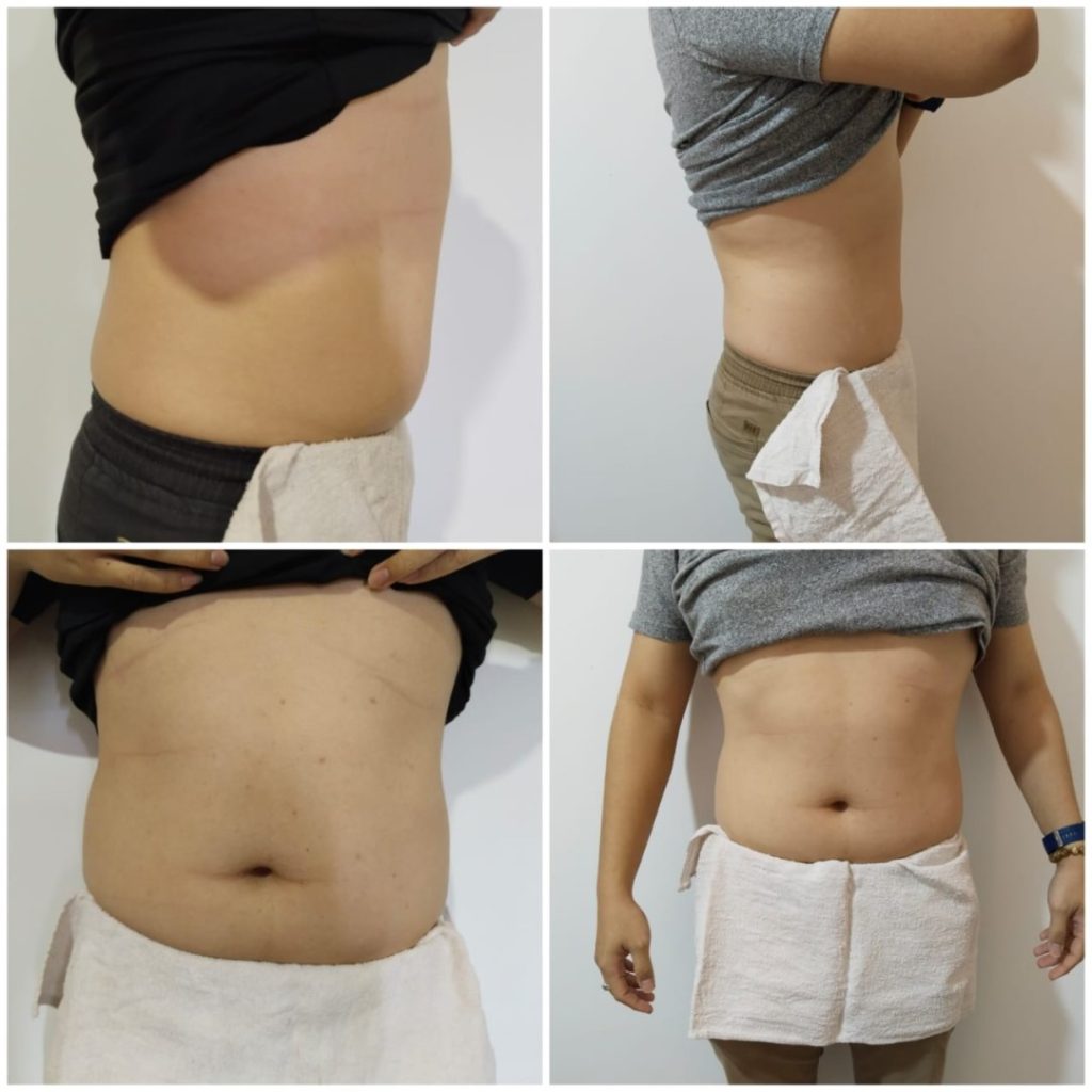 EMS body sculpting machine weight loss before and after comparison pictures