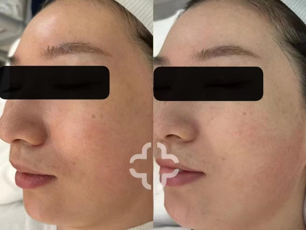 Photorejuvenation before and after comparison