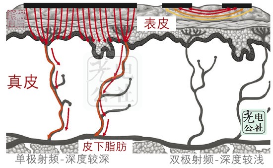 Subcutaneous depth of monopolar RF and bipolar RF