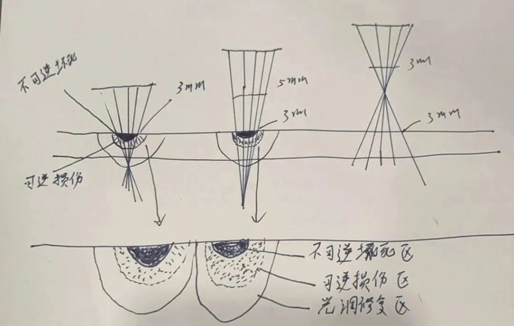 The degree of skin damage caused by 1064nm laser with different spot sizes