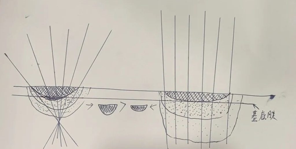 The divergence of laser light after it enters the skin.